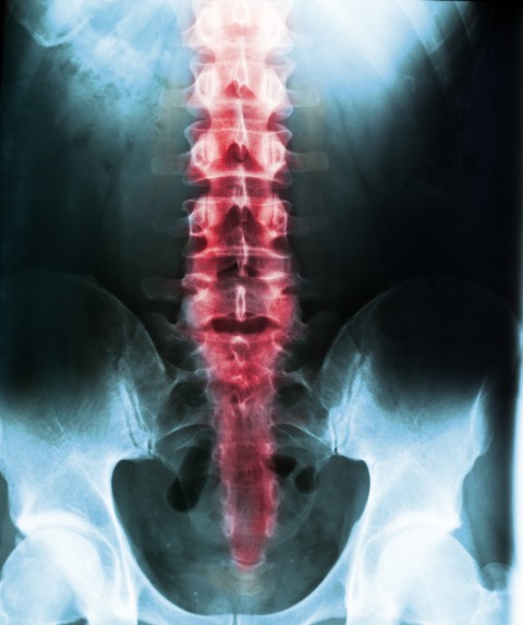 when is spinal fusion necessary